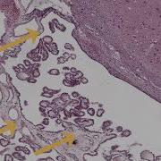 Ventricles Of The Brain Choroid Plexus