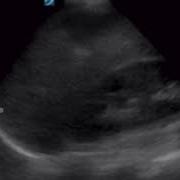 Mirror Artifact At A Normal Lung Base