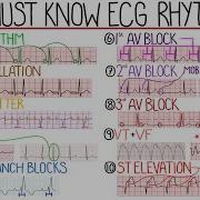 Most Common ECG Patterns You Should Know
