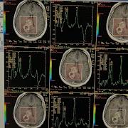 Mri Spectroscopy Post Processing Mrs Hindi Easy Method MrBean MashaBearRUSSIAN