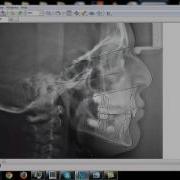 Digital Cephalometry Superimposition All Steps