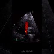 What Type Of VSD Is This Ventricularseptaldefect VSD Echocardiography Cardiology