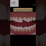 Composite Filling For Fractured Tooth Brokentooth Cavity Dentist