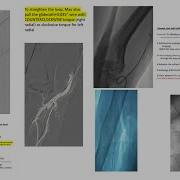 Radial Loops Difficult Radial Subclavian And Aortic Anatomy Step By Step Cases Perforation