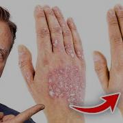 The 1 Best Remedy For Eczema