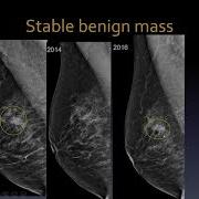 Mammography Interpretation