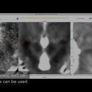 Lead DBS Norman Toolbox Refine Atlas Fit Feature Primer