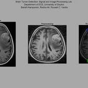 Brain Tumor Detection Using Deep Learning