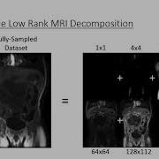 Compressed Sensing MRI With Multiscale Low Rank