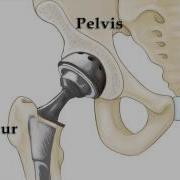 Dislocation After Total Hip Replacement