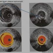 Intravascular Ultrasound IVUS Elias Hanna Univ Of Iowa