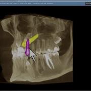3D Tooth Segmentation Tool How To Segment Many Teeth Easily
