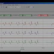 Peak Max From Accelerometer Data