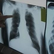 Big Money Black Lung And Doctors For The Coal Companies