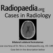 Bilateral Subdural Hematomas Radiopaedia Org Cases In Radiology