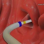 Balloon Eustachian Tube Dilation To Treat Eustachian Tube Dysfunction