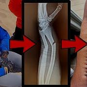 Сломаю себе РУКУ чтобы больше никому не пришлось это делать НЕОБХОДИМА ОПЕРАЦИЯ