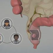 Patient Teaching Low Anterior Resection Surgical Management Of Rectal Cancer TVASurg