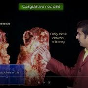 Necrosis And Types Of Necrosis General Pathology Animated Usmle Videos