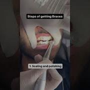 3 Steps Of Getting Braces Braces Procedure In Lahore Orthodontic Treatment Dental Aesthetics