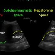 Basic Ultrasound Course EFAST