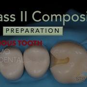 Class II MO Composite Preparation With Caries 14 Acadental Part 1