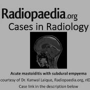 Acute Mastoiditis With Subdural Empyema Radiopaedia Org Cases In Radiology