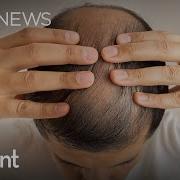 Popular Hair Loss Drug Finasteride Can Have Life Altering Side Effects The Current