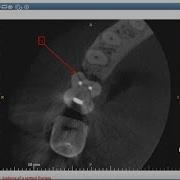 Carestream 3D Imaging Создание стрелок и аннотаций