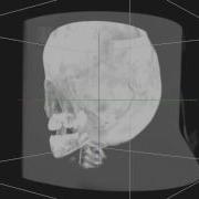 2D Texture Based Volume Rendering