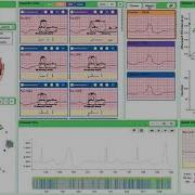 ECGLens Interactive Visual Exploration Of Large Scale ECG Data For Arrhythmia Detection