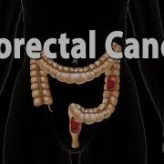 Colon Cancer Pathology Symptoms Screening Cause And Risk Factors Animation