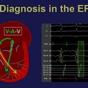Diagnosis Of SVT In The EP Lab