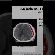 SUBDURAL HEMATOMA WITH SHIFT Shorts Tbi Traumaticbraininjury Braininjury Health