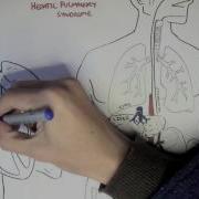 Liver Cirrhosis