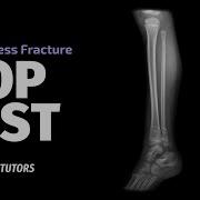Hop Test Tibial Stress Fractures