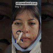 DIET For FAST Wisdom Teeth Removal Recovery Wisdomteethremovalrecovery Wisdomtoothremoval
