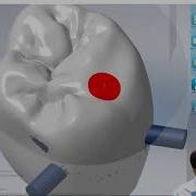 MillBox 2019 Hybrid Abutment And Screw Retained Workflow
