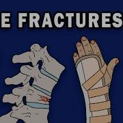 BONE FRACTURES