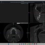 Acteon Tooth Segmentation Using Artificial Intelligence Quick Demo