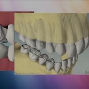 Communicating Occlusion