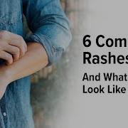 6 Common Rashes And What They Look Like Healthline
