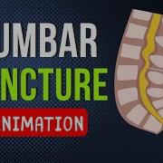 LUMBAR PUNCTURE LP SPINAL TAP TECHNIQUE ANATOMY SAMPLE ANIMATION