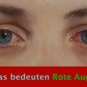 Was Bedeuten Rote Augen Und Warum Können Sie Entstehen