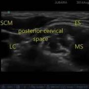 Intermediate Cervical Plexus Block