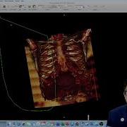 How To Creating A 3D Reconstruction Of Your Patient S CT Scan