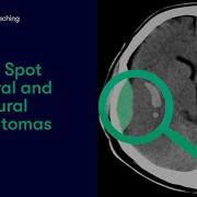 Extradural Vs Subdural Haematomas How Do We Diagnose Them On CT