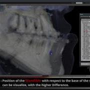 3D Ceph Pre Post Treatment Comparison