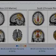 Real Time SwLoreta Neurofeedback Of Veterans With PTSD