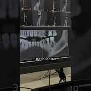 УЖАСНО красиво КИСТА зуба Они видны ТОЛЬКО на КТ